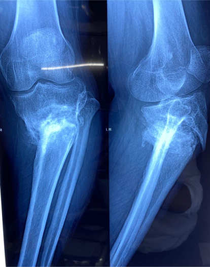 Difficult primary joint replacement