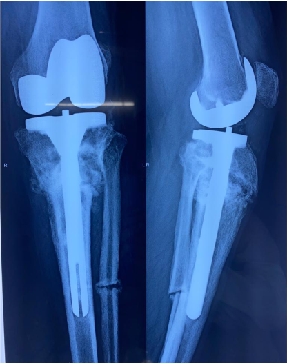 Difficult primary joint replacement