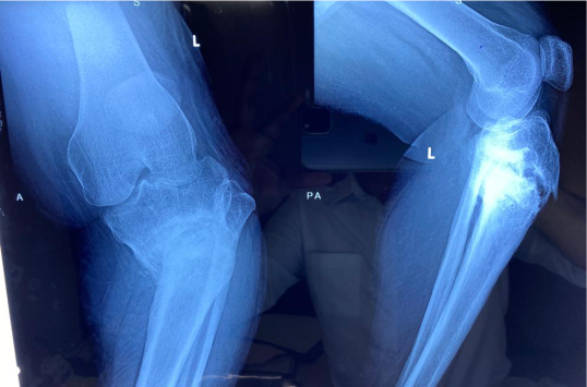 Difficult primary joint replacement