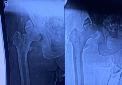 Difficult primary joint replacement