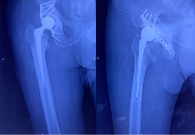 Difficult primary joint replacement