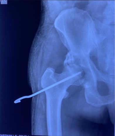 Difficult primary joint replacement