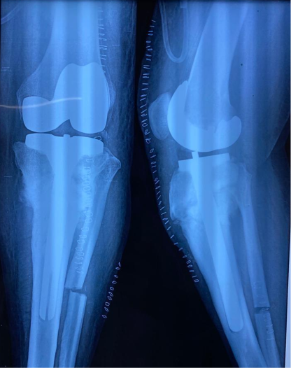 Difficult primary joint replacement 3