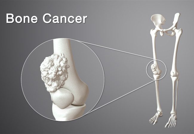 Orthopaedics oncology/ Bone & soft tissue tumours